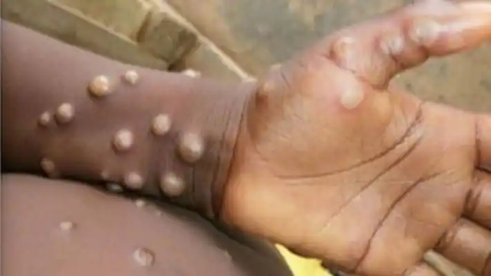 Monkeypox : പ്രതിരോധിക്കാൻ സത്വര നടപടി വേണമെന്ന് WHO, രോഗബാധയുണ്ടായാൽ നേരിടാൻ സജ്ജമെന്ന് ICMR